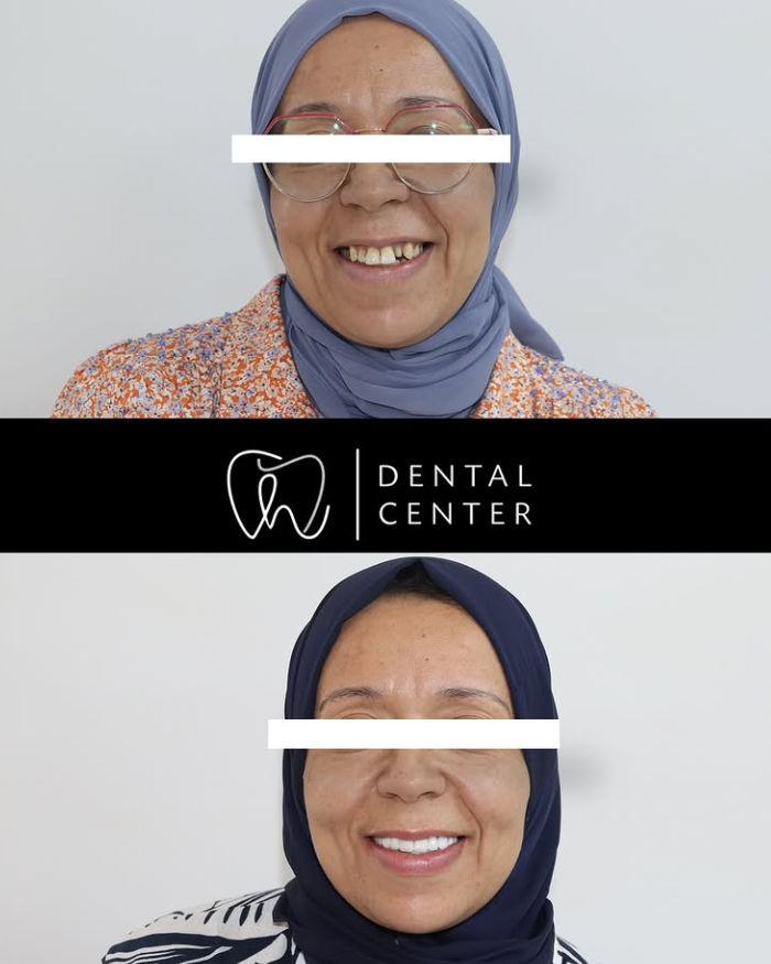 Transformation du sourire — patiente 1, avant et après