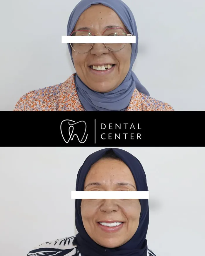 Transformation du sourire — patiente 1, avant et après