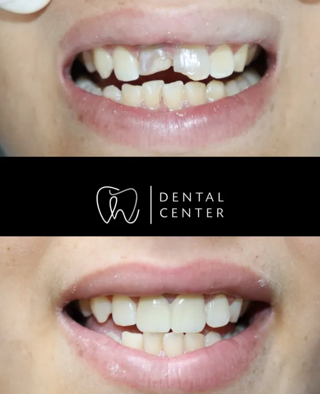 Transformation du sourire — patient 6, avant et après