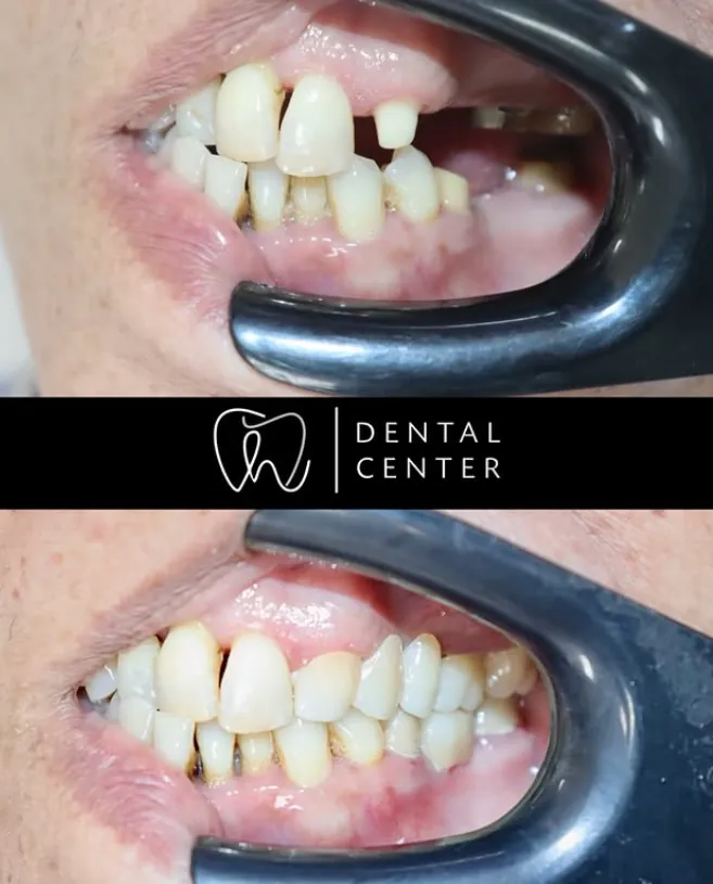 Transformation du sourire — patient 7, avant et après
