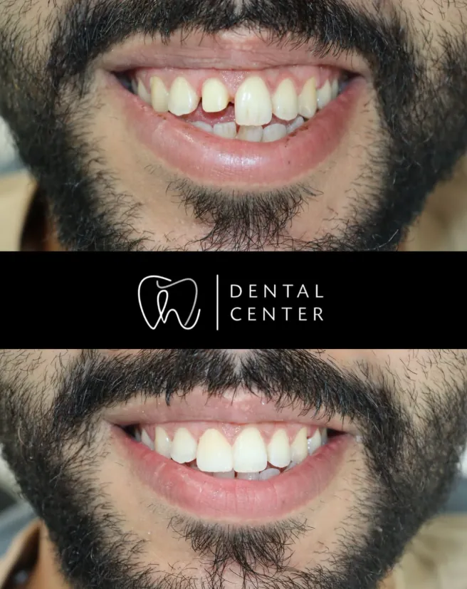 Transformation du sourire — patient 8, avant et après