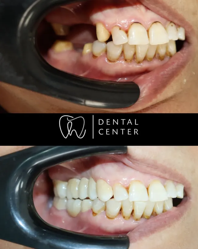 Transformation du sourire — patient 9, avant et après