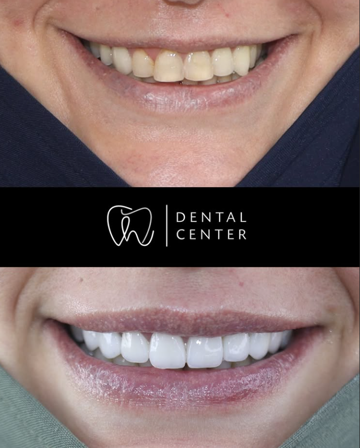 Transformation du sourire — patient 2, avant et après