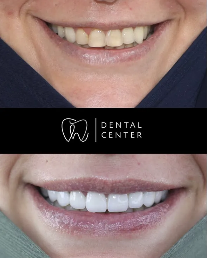 Transformation du sourire — patient 2, avant et après