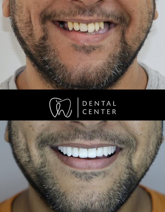 Transformation du sourire — patient 3, avant et après