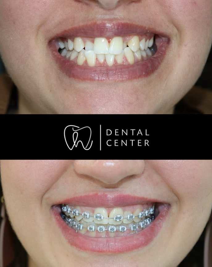 Transformation du sourire — patient 4, avant et après