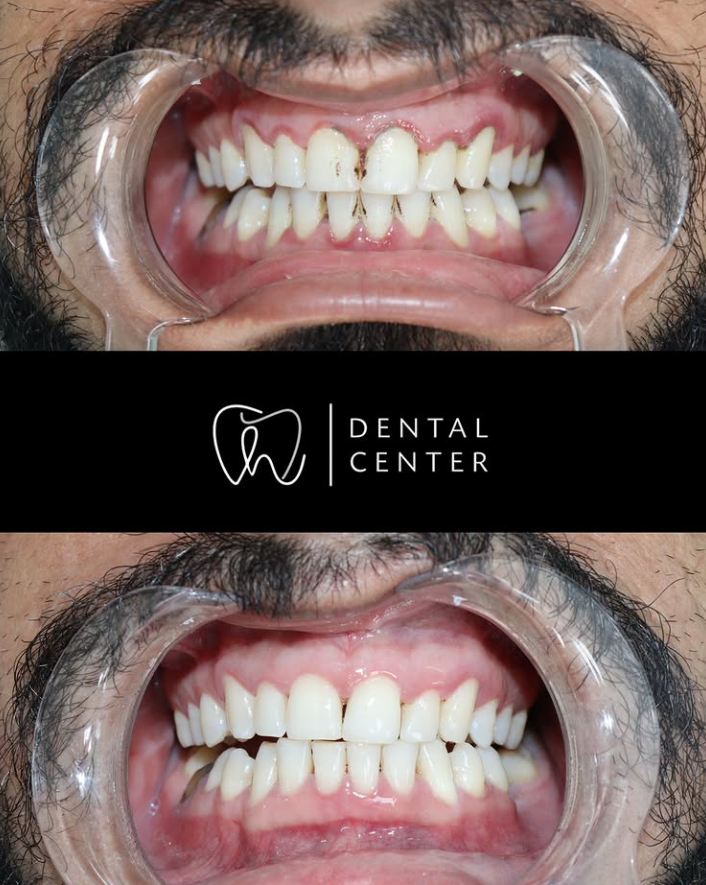 Transformation du sourire — patient 5, avant et après