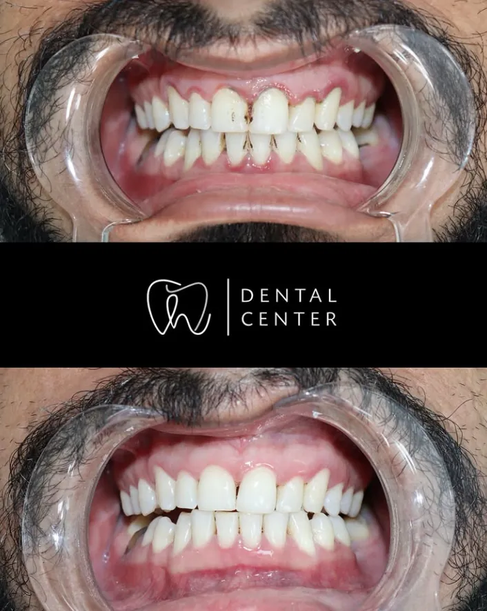 Transformation du sourire — patient 5, avant et après
